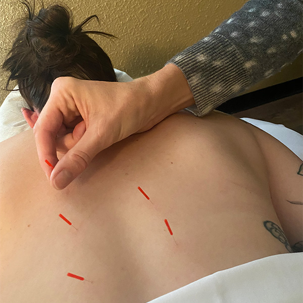 Acupuncture Greenwood Village Denver CO 80111